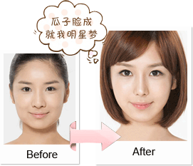 韩式改脸型案例